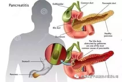 胰腺健康新篇章：全新急性胰腺炎分型引领治疗新潮流